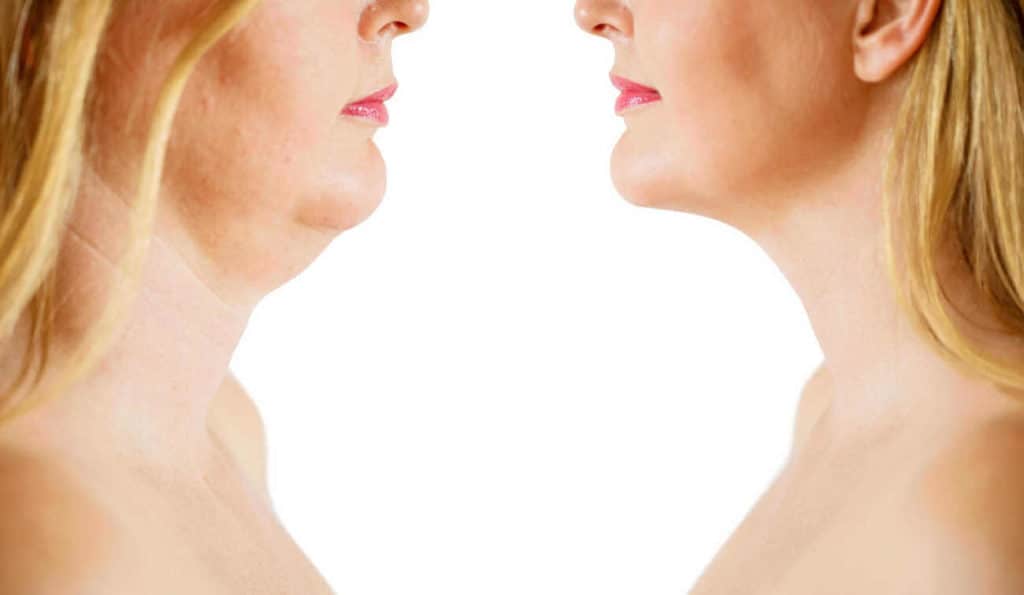 Double Chin treatment Greater London (Sutton) before and after results