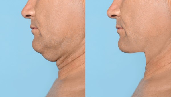 Which Non-Surgical Treatments Work Best for Jowls and Loose Skin Greater London (Sutton)?