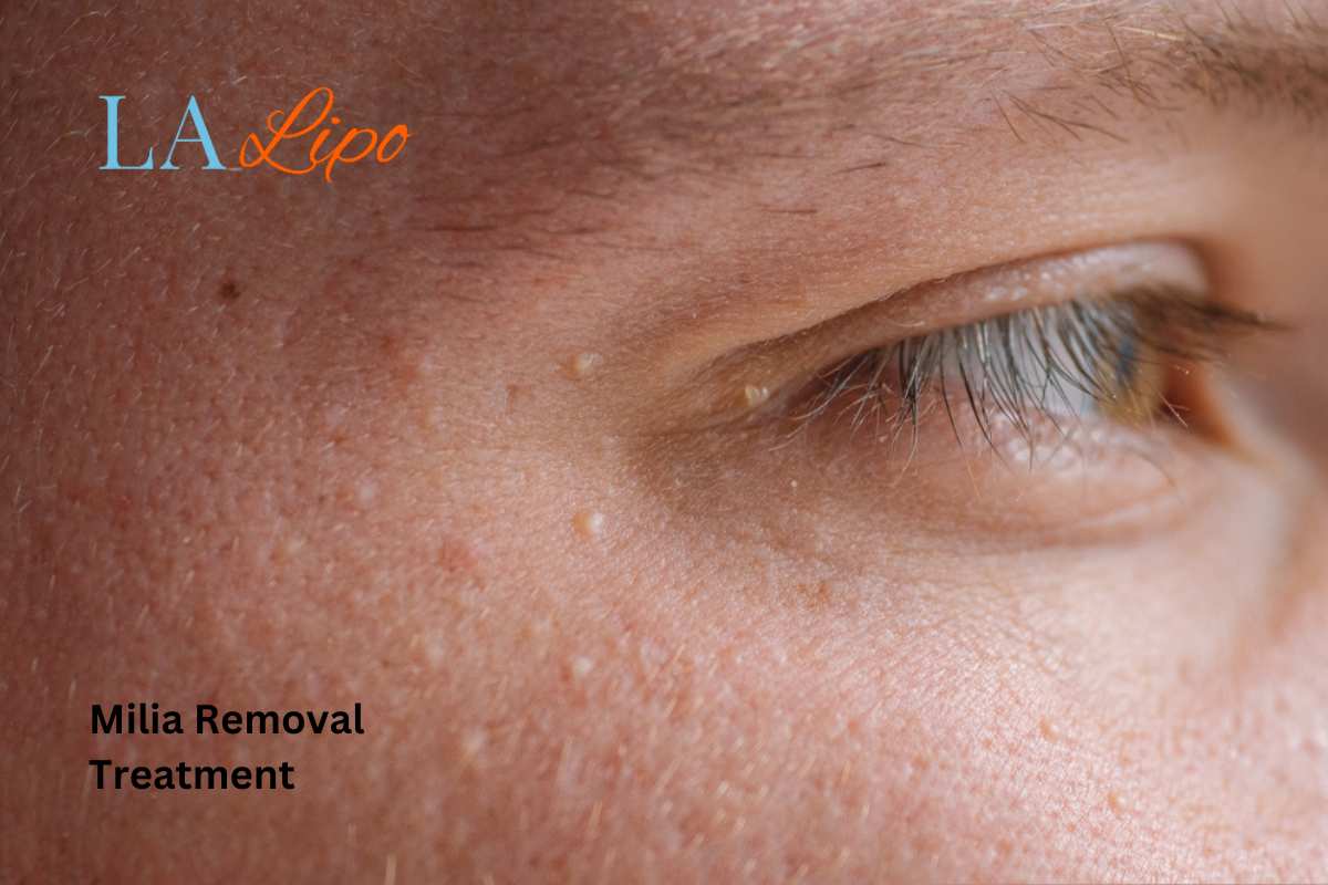 Cryopen Milia Removal: Is It the Easiest and Safest Option Greater London (Sutton)?