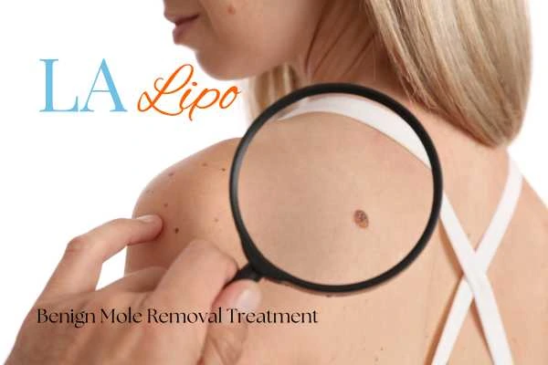 Woman having her inspection of blemish before mole removal Greater London (Sutton)
