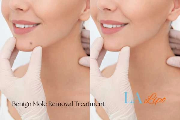 woman's before and after mole removal Greater London (Sutton) results