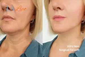 hi-fu for wrinkles Greater London (Sutton) before and after results