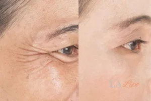 Before and after results of woman - HI-fu wrinkles reduction treatment Greater London (Sutton)