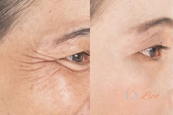 Before and after results of woman - HI-fu wrinkles reduction treatment Greater London (Sutton)