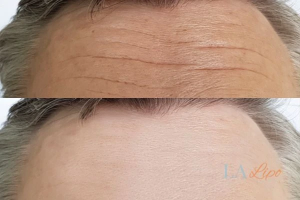 results of HIFU Greater London (Sutton) on mans forehead to help reduce lines and wrinkles