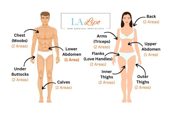 LA LIPO Cryolipolysis Areas Greater London (Sutton)