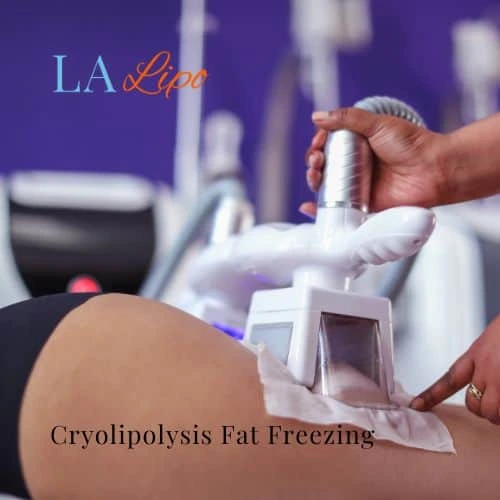 fat freezing - Cryolipolysis Greater London (Sutton)
