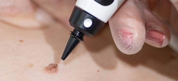skin tag removal using cryopen Greater London (Sutton)