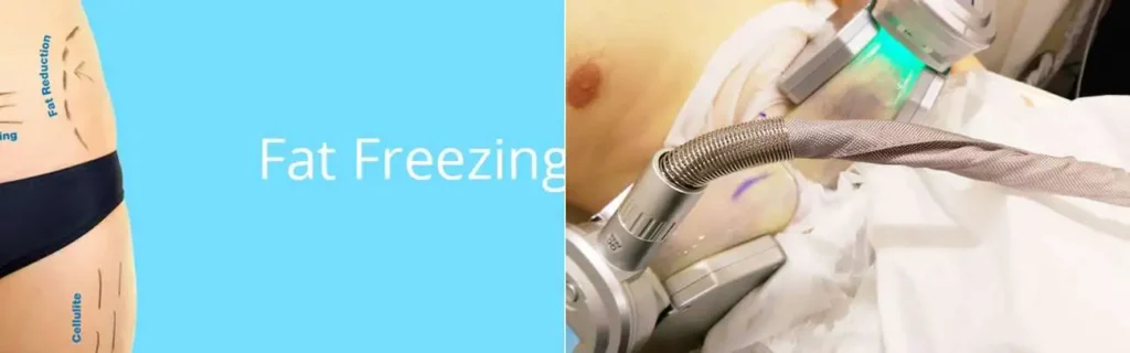 Fat freezing Greater London (Sutton) on multiple areas of the body