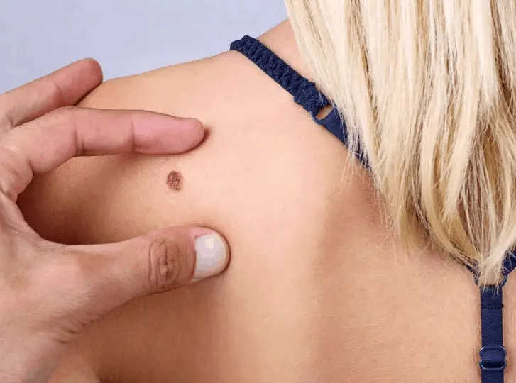 woman having mole removal Greater London (Sutton) consultation before treatment.