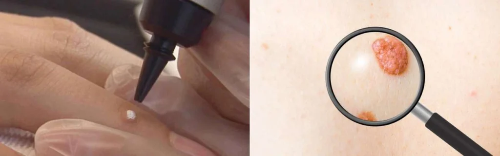Person getting moles removed with cryopen Greater London (Sutton)