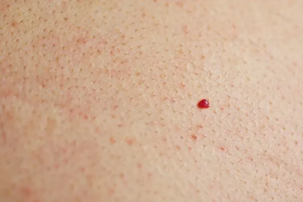 close up of a cherry angioma Greater London (Sutton)