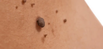 image of a skin tag Greater London (Sutton)