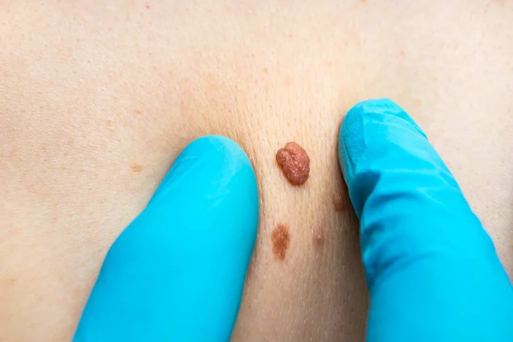 Consultant examining a skin tag Greater London (Sutton)