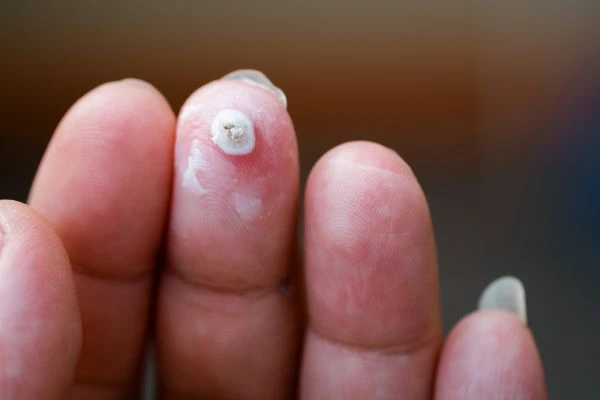 wart on person finger - cryotherapy to treat from LA LIPO Greater London (Sutton)