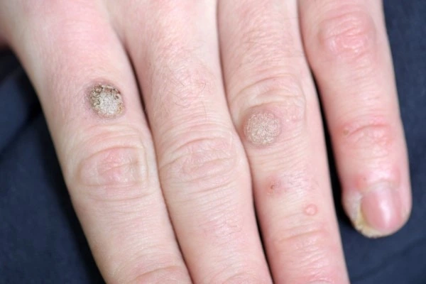 photo of warts on person hand - see wart removal Greater London (Sutton) from LA LIPO