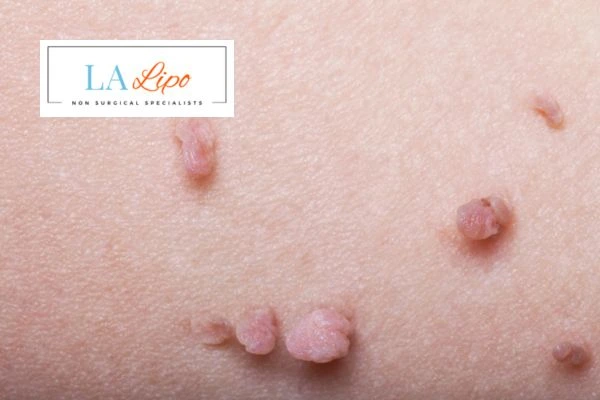 Does cryopen skin tag removal Greater London (Sutton) hurt? Find out now call our team today!