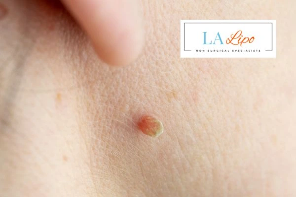 Book skin tag removal Greater London (Sutton) today speak to our team now!