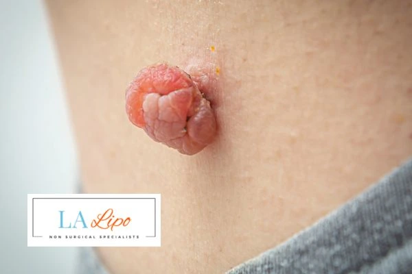 Interested in skin tag removal Greater London (Sutton)? Concerned about the pain? Find out more today!