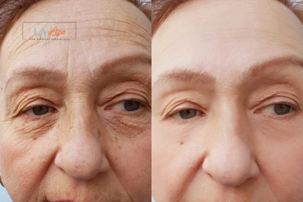 The powerful benefits of Morpheus8 Treatment Greater London (Sutton) - Call Our team today!