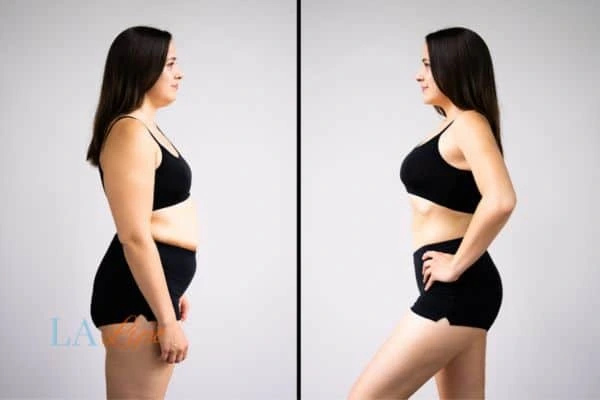 Picture of womans before and after using LA-EMS body sculpting to improve her core strength Greater London (Sutton)