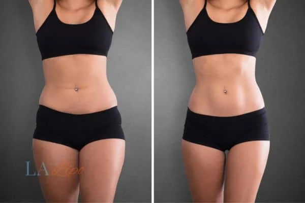 before and after results of non-surgical treatment to help a woman's body image and mental health Greater London (Sutton)