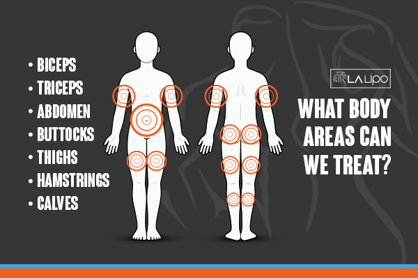 Diagram to show areas you can have LA-EMS Body Sculpting Treatment Greater London (Sutton)