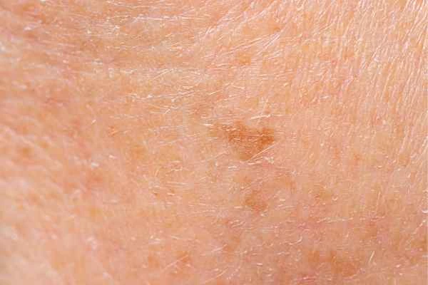 close up picture of age spots Greater London (Sutton)