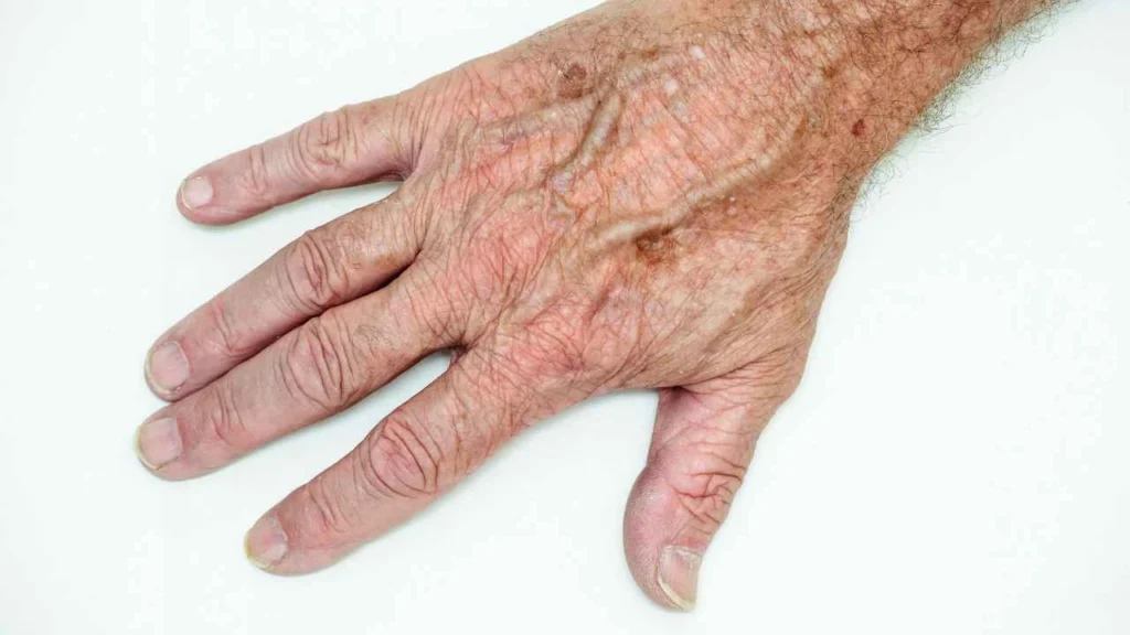 Male hand showing age spot Greater London (Sutton)
