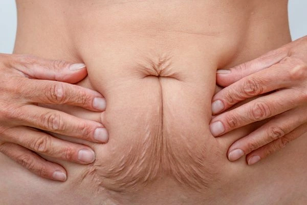 Image of a woman's stomach with loose skin - example of skin tightening Greater London (Sutton) options