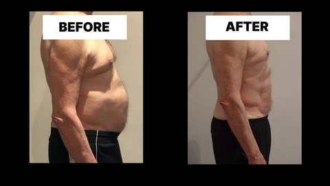 What Symptoms Can Diastasis Recti Cause in Men? Weak Core, Back Pain and Poor Posture Greater London (Sutton)